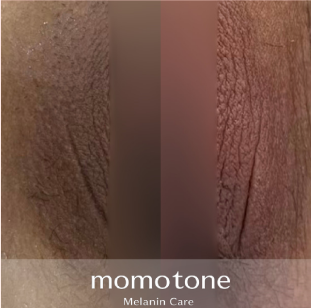 CASE 02 ─ デリケートゾーンの色素ケア(momotoneの施術事例 BEFORE × AFTER)